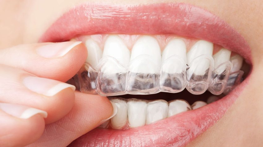 Guide to Getting the Best Invisalign, Singapore