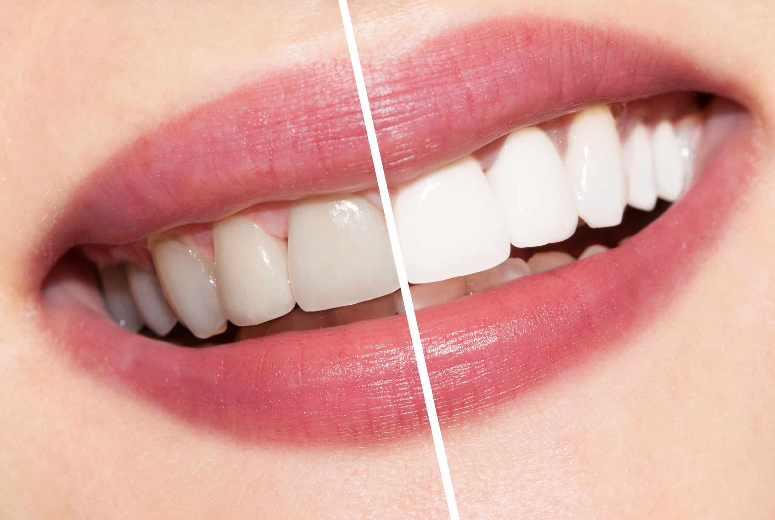 Some Interesting Facts about Teeth Whitening