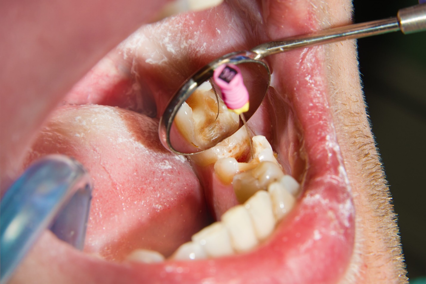 Is an Emergency Dentist Qualified to Perform a Root Canal Treatment?