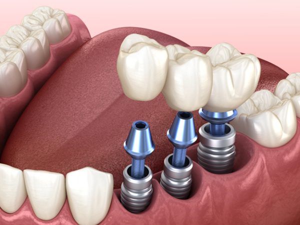 Examining the Limitations and Prohibitions of Dental Implants
